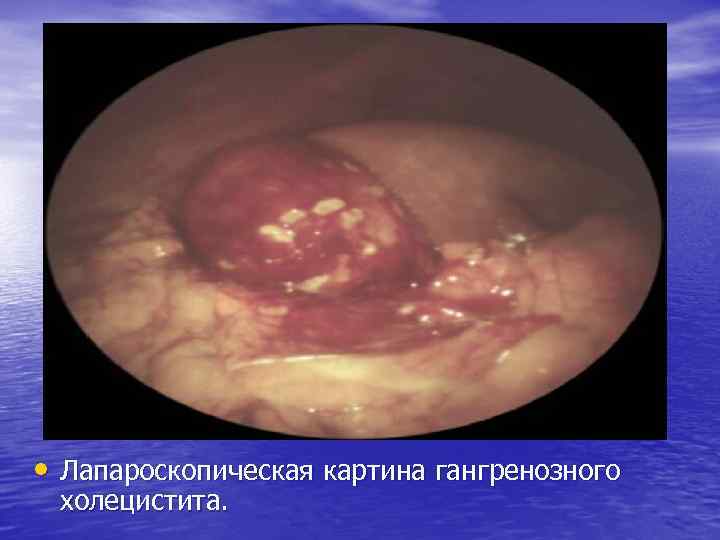  • Лапароскопическая картина гангренозного холецистита. 