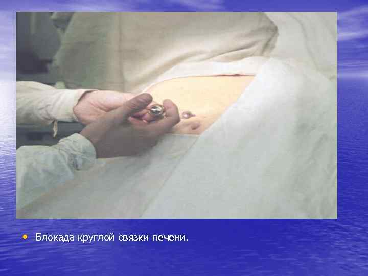  • Блокада круглой связки печени. 