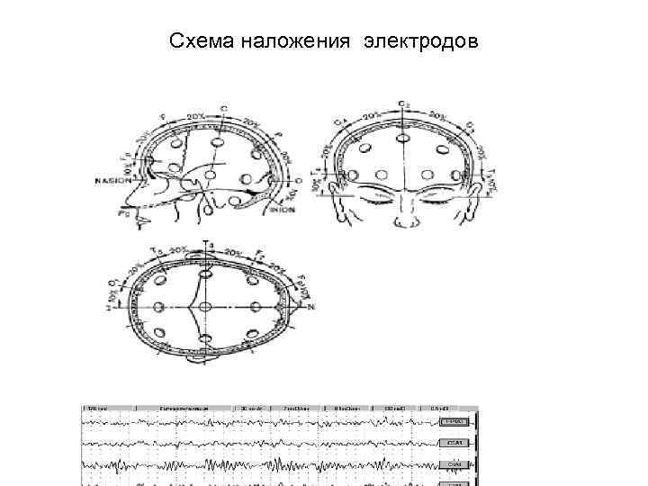 Схема наложения электродов 