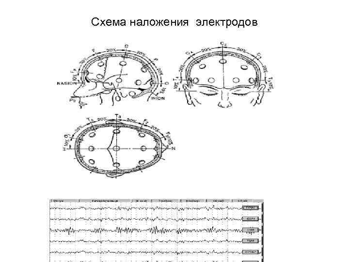 Схема наложения электродов 