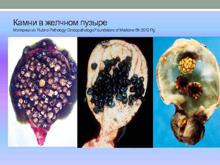 Камни в желчном пузыре Материал из: Rubins Pathology Clinicopathologic Foundations of Medicine 6 th