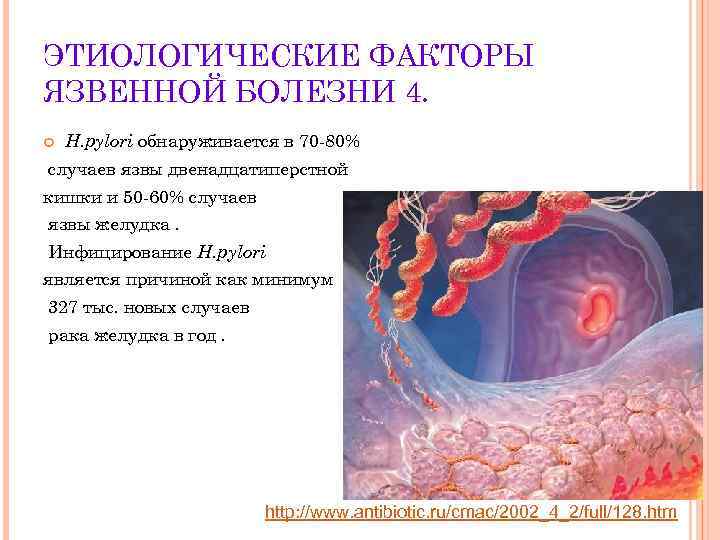ЭТИОЛОГИЧЕСКИЕ ФАКТОРЫ ЯЗВЕННОЙ БОЛЕЗНИ 4. H. pylori обнаруживается в 70 -80% случаев язвы двенадцатиперстной