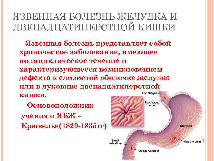 ЯЗВЕННАЯ БОЛЕЗНЬ ЖЕЛУДКА И ДВЕНАДЦАТИПЕРСТНОЙ КИШКИ Язвенная болезнь представляет собой хроническое заболевание, имеющее полициклическое