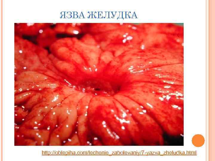 ЯЗВА ЖЕЛУДКА http: //oblepiha. com/lechenie_zabolevaniy/7 -yazva_zheludka. html 