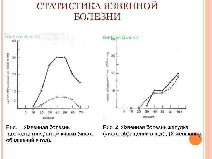 СТАТИСТИКА ЯЗВЕННОЙ БОЛЕЗНИ Рис. 1. Язвенная болезнь двенадцатиперстной кишки (число обращений в год). Рис.
