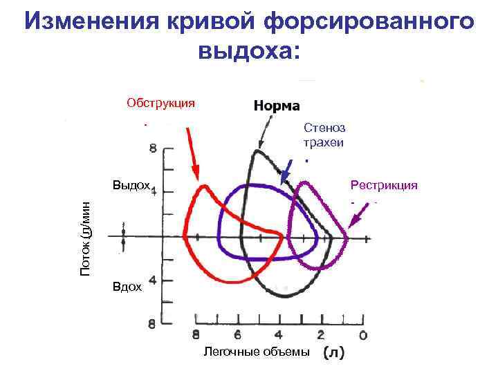 Изменения кривой форсированного выдоха: Обструкция Стеноз трахеи Рестрикция Поток (л/мин Выдох ) Вдох Легочные