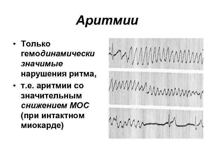 Аритмии • Только гемодинамически значимые нарушения ритма, • т. е. аритмии со значительным снижением