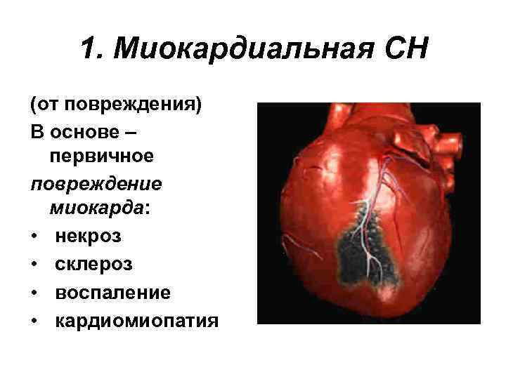 1. Миокардиальная СН (от повреждения) В основе – первичное повреждение миокарда: • некроз •