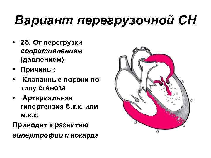 Вариант перегрузочной СН • 2 б. От перегрузки сопротивлением (давлением) • Причины: • Клапанные