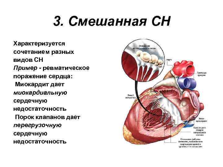 3. Смешанная СН Характеризуется сочетанием разных видов СН Пример - ревматическое поражение сердца: Миокардит