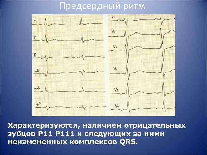 Предсердный ритм Характеризуются, наличием отрицательных зубцов Р 111 и следующих за ними неизмененных комплексов