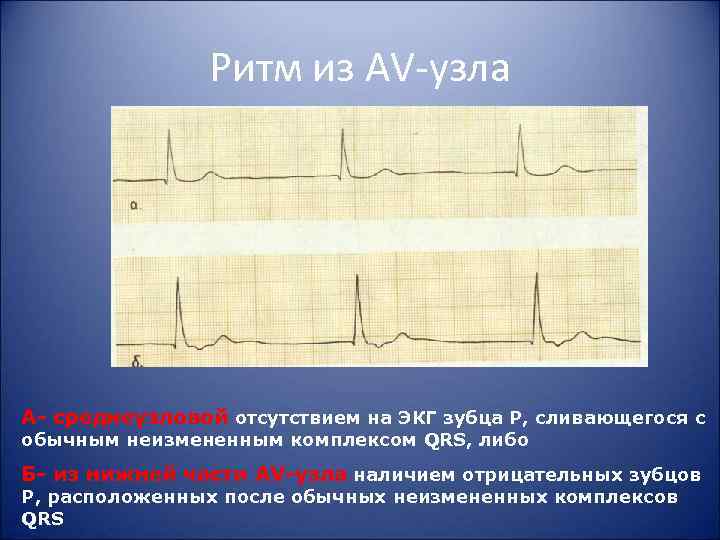 Ритм из AV узла А среднеузловой отсутствием на ЭКГ зубца Р, сливающегося с обычным