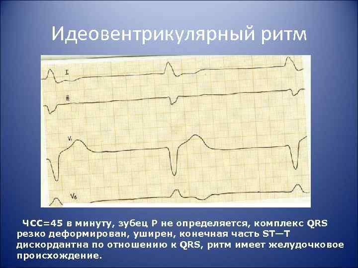 Идеовентрикулярный ритм ЧСС=45 в минуту, зубец Р не определяется, комплекс QRS резко деформирован, уширен,