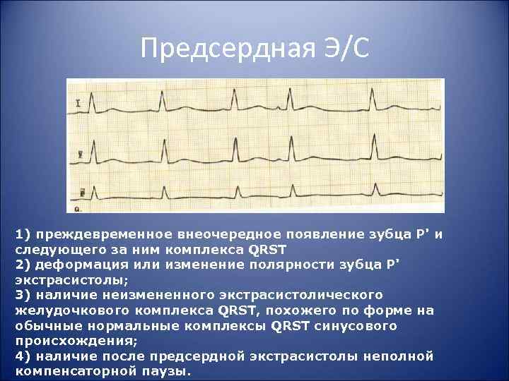 Предсердная Э/С 1) преждевременное внеочередное появление зубца Р' и следующего за ним комплекса QRST