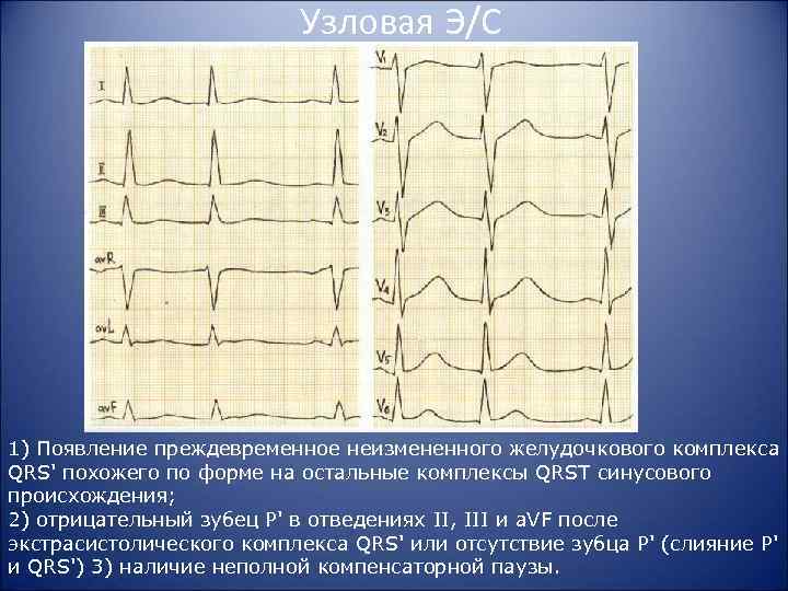 Узловая Э/С 1) Появление преждевременное неизмененного желудочкового комплекса QRS' похожего по форме на остальные