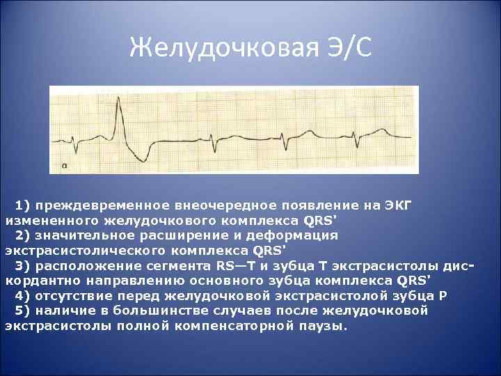 Желудочковая Э/С 1) преждевременное внеочередное появление на ЭКГ измененного желудочкового комплекса QRS' 2) значительное