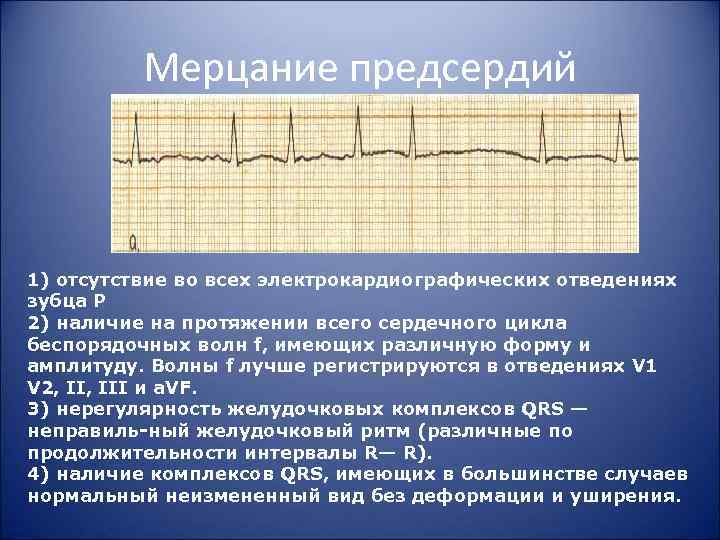 Мерцание предсердий 1) отсутствие во всех электрокардиографических отведениях зубца P 2) наличие на протяжении