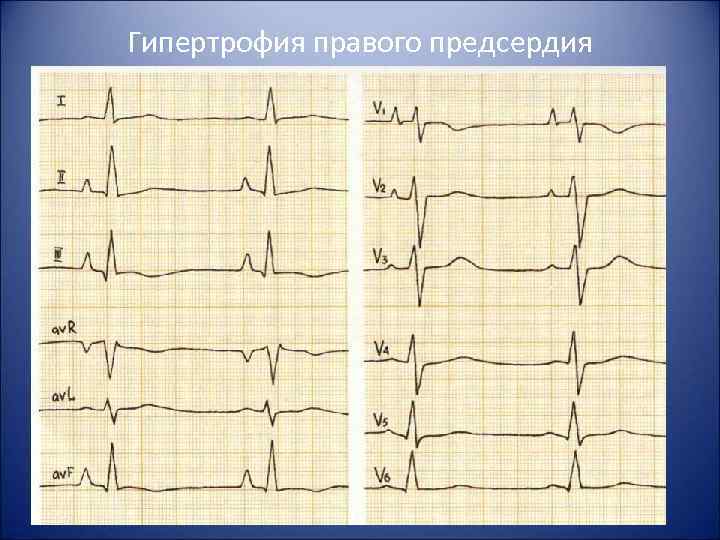 Гипертрофия правого предсердия 