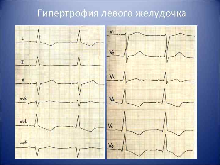 Гипертрофия левого желудочка 