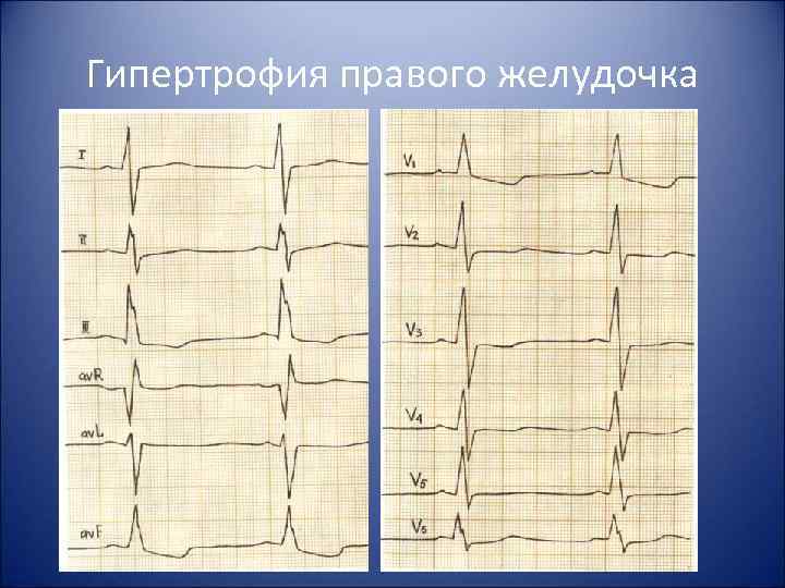 Гипертрофия правого желудочка 