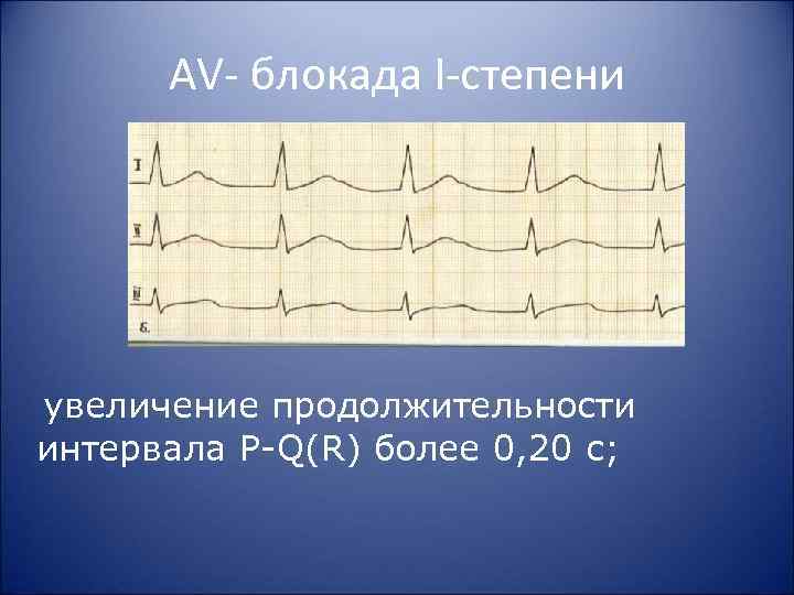 AV блокада I степени увеличение продолжительности интервала P Q(R) более 0, 20 с; 