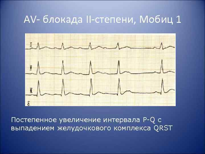 AV блокада II степени, Мобиц 1 Постепенное увеличение интервала P Q c выпадением желудочкового