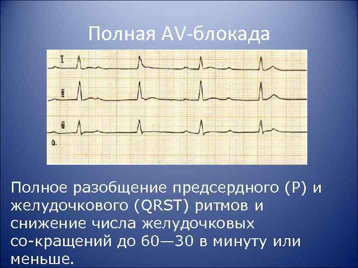 Полная AV блокада Полное разобщение предсердного (Р) и желудочкового (QRST) ритмов и снижение числа