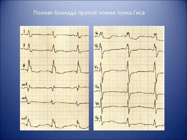 Полная блокада правой ножки пучка Гиса 