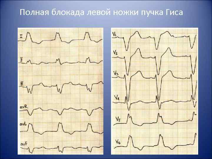 Полная блокада левой ножки пучка Гиса 