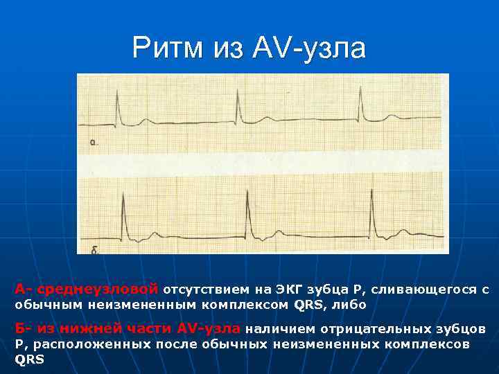 Ритм из AV-узла А среднеузловой отсутствием на ЭКГ зубца Р, сливающегося с обычным неизмененным