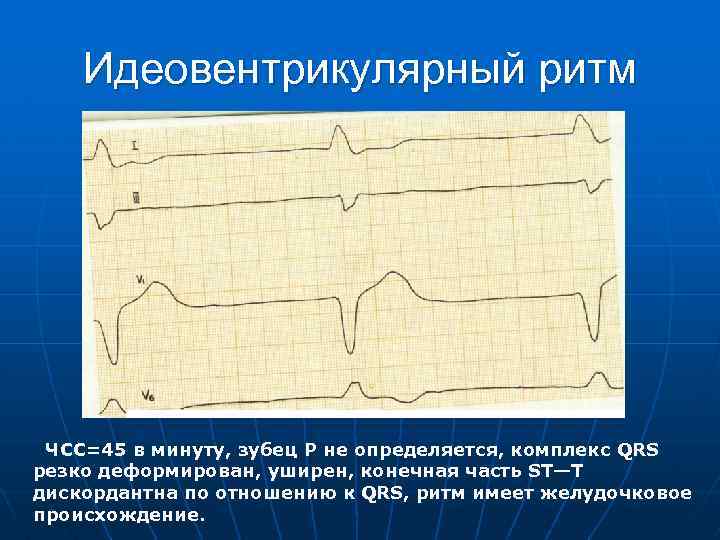 Идеовентрикулярный ритм ЧСС=45 в минуту, зубец Р не определяется, комплекс QRS резко деформирован, уширен,