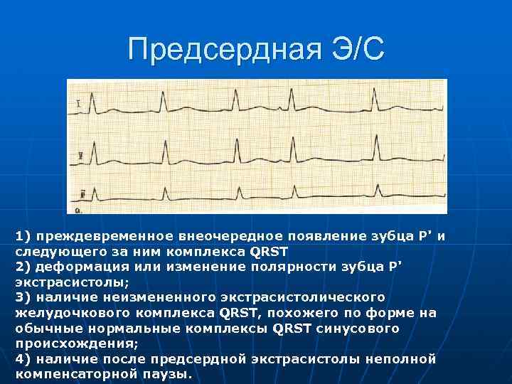 Предсердная Э/С 1) преждевременное внеочередное появление зубца Р' и следующего за ним комплекса QRST