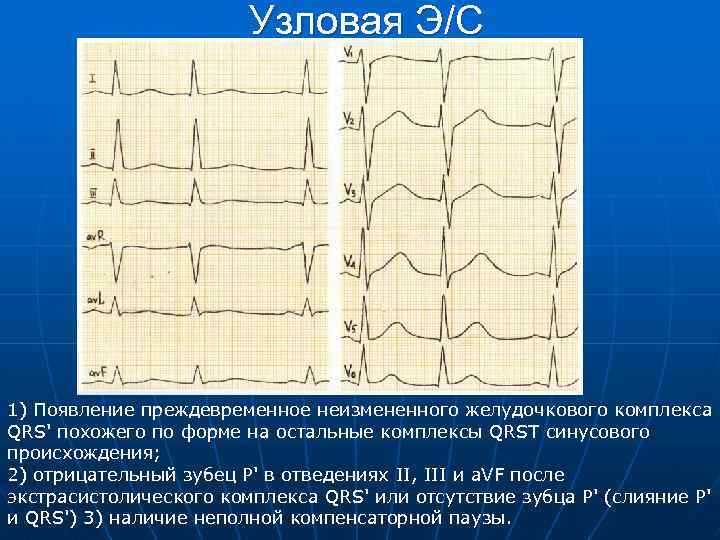 Узловая Э/С 1) Появление преждевременное неизмененного желудочкового комплекса QRS' похожего по форме на остальные