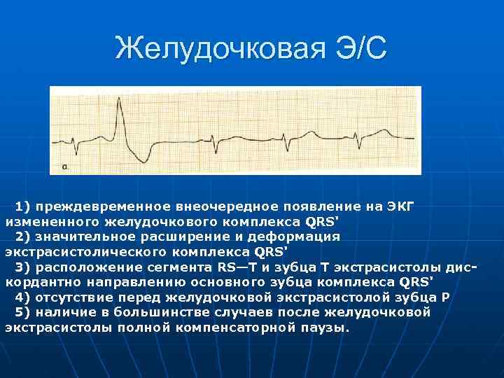 Желудочковая Э/С 1) преждевременное внеочередное появление на ЭКГ измененного желудочкового комплекса QRS' 2) значительное