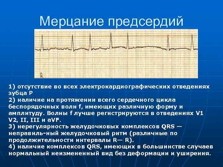 Мерцание предсердий 1) отсутствие во всех электрокардиографических отведениях зубца P 2) наличие на протяжении