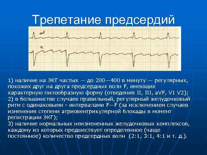 Трепетание предсердий 1) наличие на ЭКГ частых — до 200— 400 в минуту —