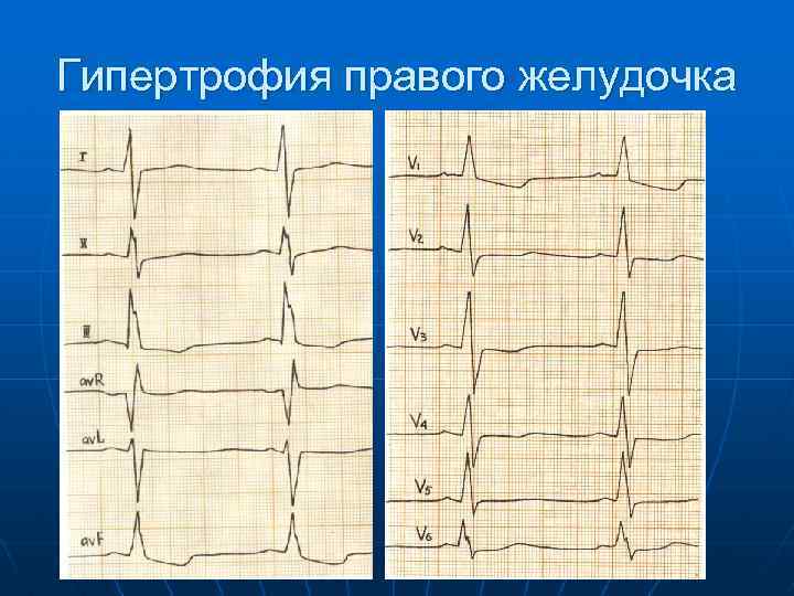 Гипертрофия правого желудочка 