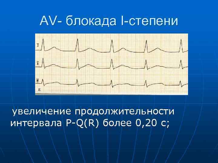 AV- блокада I-степени увеличение продолжительности интервала P Q(R) более 0, 20 с; 