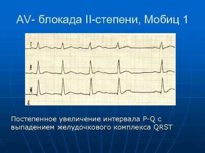 AV- блокада II-степени, Мобиц 1 Постепенное увеличение интервала P Q c выпадением желудочкового комплекса