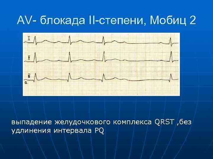 AV- блокада II-степени, Мобиц 2 выпадение желудочкового комплекса QRST , без удлинения интервала PQ