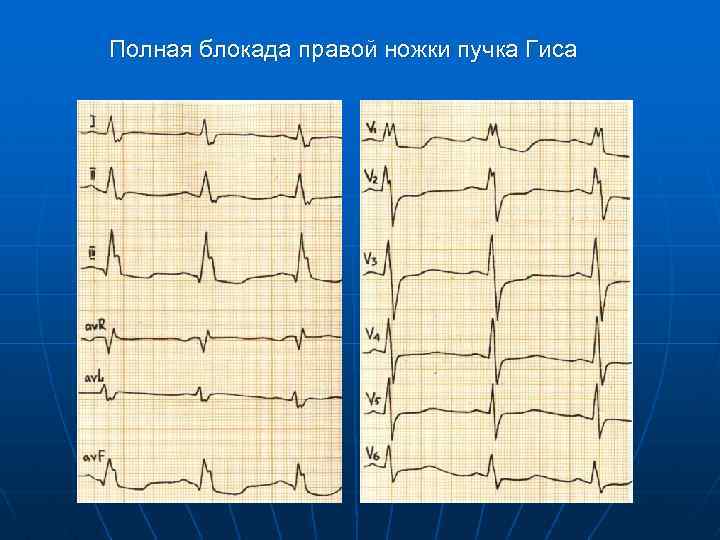 Полная блокада правой ножки пучка Гиса 