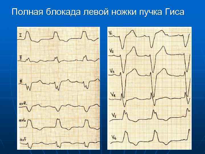 Полная блокада левой ножки пучка Гиса 