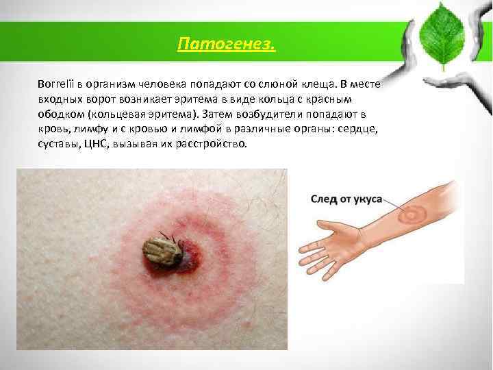 Патогенез. Borrelii в организм человека попадают со слюной клеща. В месте входных ворот возникает