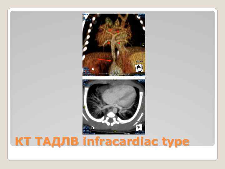 КТ ТАДЛВ infracardiac type 