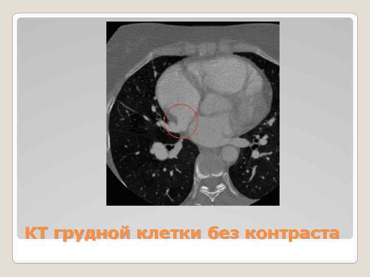 КТ грудной клетки без контраста 