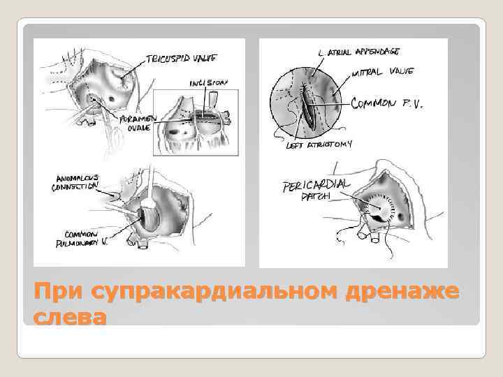 При супракардиальном дренаже слева 