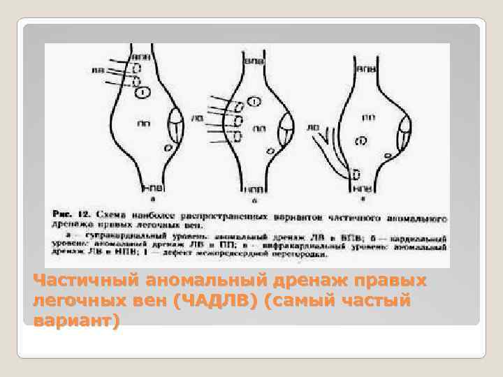 Частичный аномальный дренаж правых легочных вен (ЧАДЛВ) (самый частый вариант) 