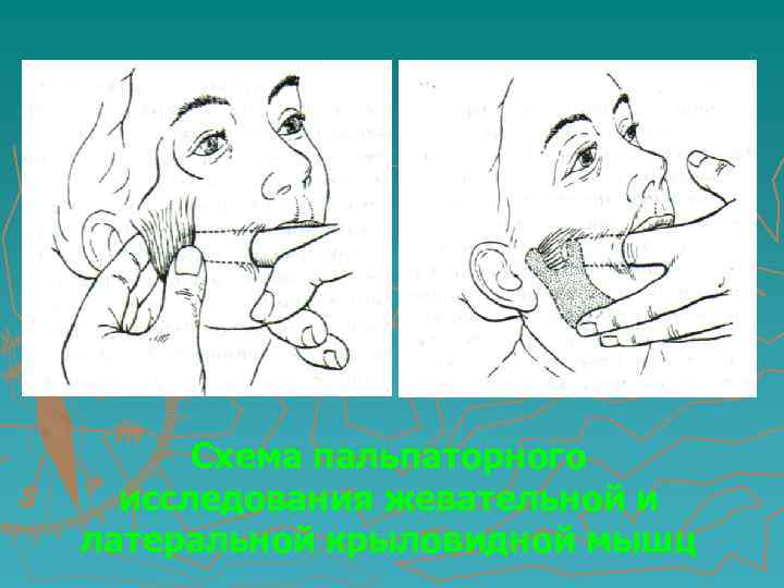 Схема пальпаторного исследования жевательной и латеральной крыловидной мышц 