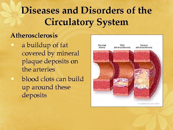 Diseases and Disorders of the Circulatory System Atherosclerosis • a buildup of fat covered