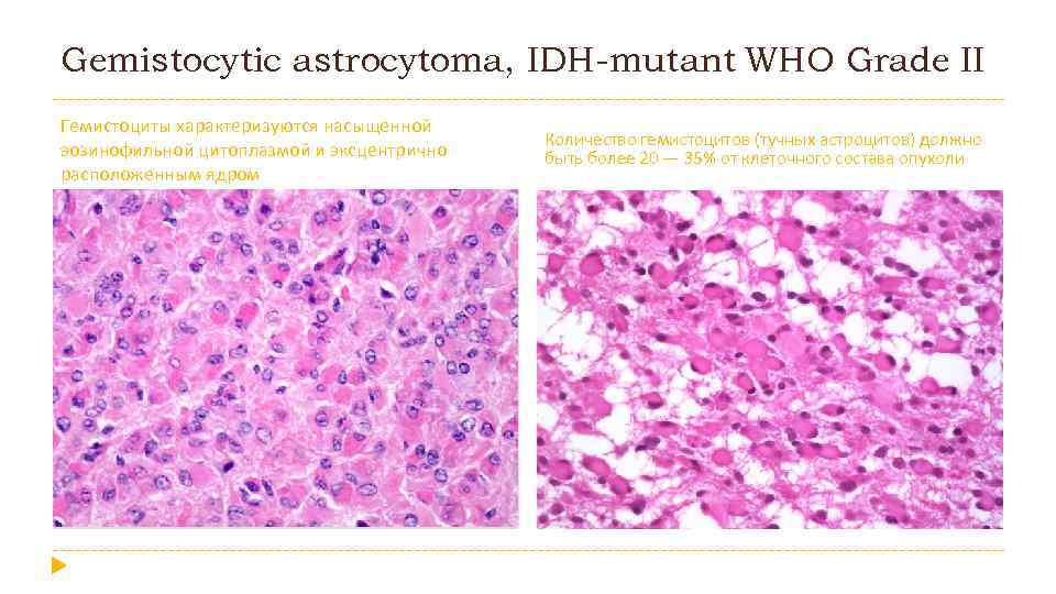 Gemistocytic astrocytoma, IDH-mutant WHO Grade II Гемистоциты характеризуются насыщенной эозинофильной цитоплазмой и эксцентрично расположенным